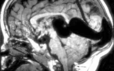 Prenatal diagnosis of cerebral vascular malformations: case series