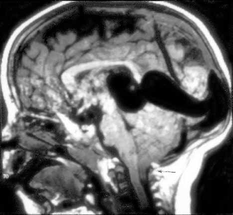 Prenatal diagnosis of cerebral vascular malformations: case series