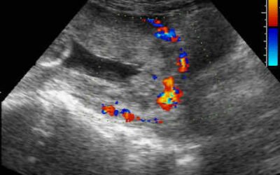 A multidisciplinary team as an intervention to improve maternal and perinatal outcomes in placenta accreta spectrum (PAS)