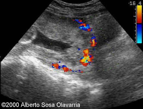 A multidisciplinary team as an intervention to improve maternal and perinatal outcomes in placenta accreta spectrum (PAS)